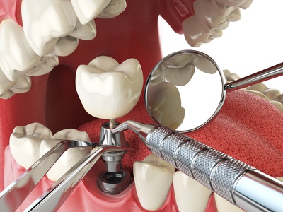 Einbringung Implantat